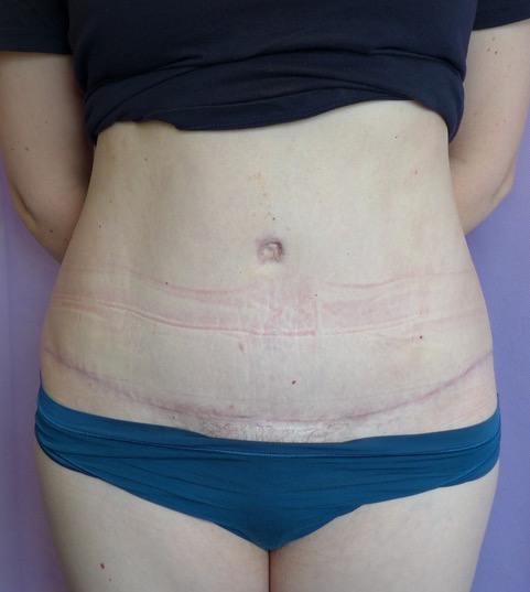 After: Abdominoplasty AP