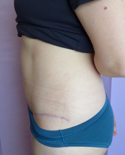 After: Abdominoplasty lateral