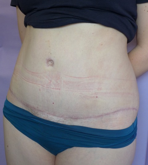 After: Abdominoplasty oblique