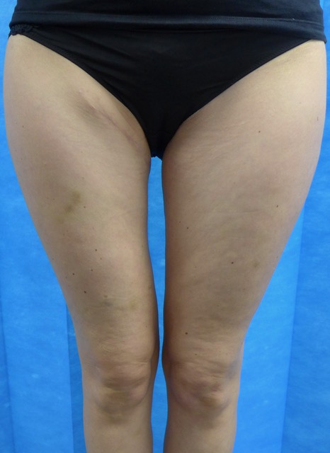 LUG flap thigh donor site scars — frontal view