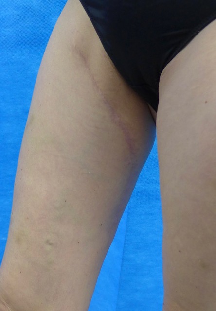 LUG flap right thigh donor site scar — lateral view