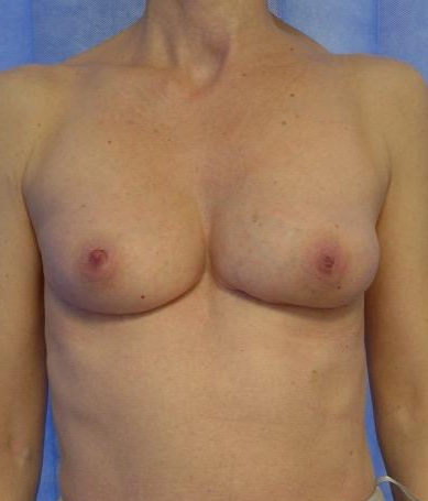 After — Breast Augmentation with Own Tissue AP