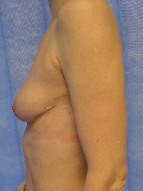 After — Breast Augmentation with Own Tissue lateral