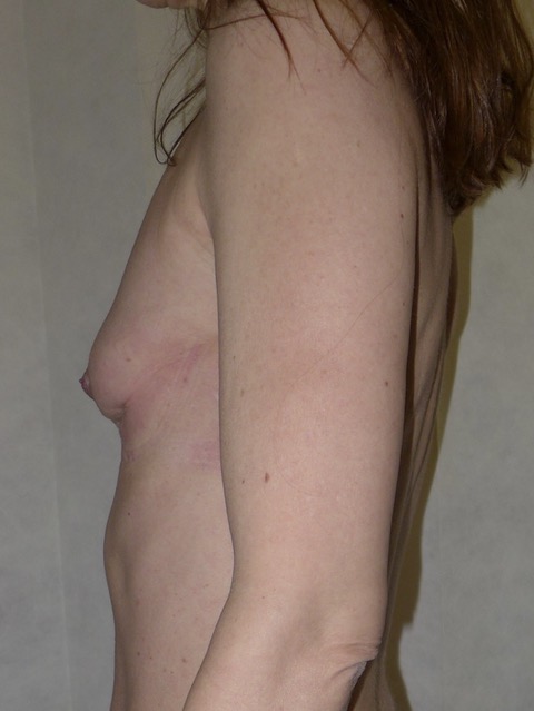 Before — Breast Augmentation with Own Tissue lateral