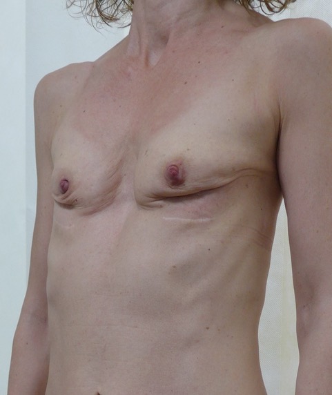 Before — Breast Augmentation with Own Tissue oblique