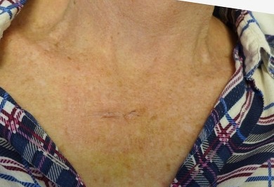 After — BCC excision décolletage, scar at 11 days