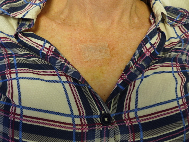 Tan 25mm 3M Micropore tape applied to BCC excision scar, décolletage