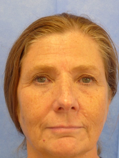 After — BCC excision glabella with glabella flap