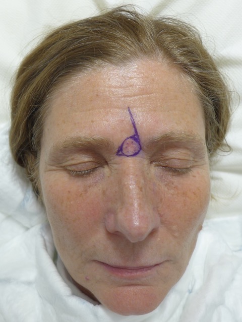 Before — BCC excision glabella with glabella flap markings