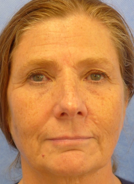 After — BCC excision top lip with perialar advancement flap, AP view