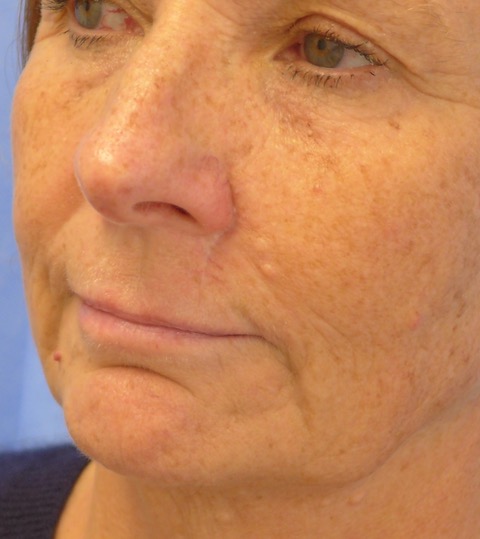 After — BCC excision top lip with perialar advancement flap, oblique view