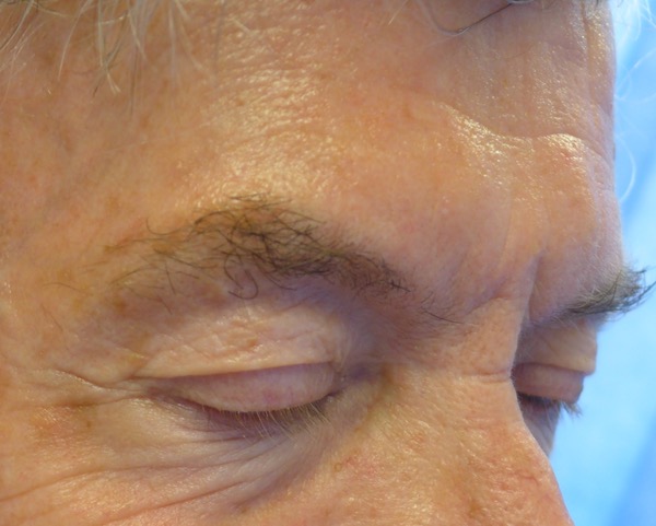 After — BCC excision right nasal sidewall near medial canthus
