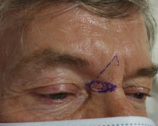 Before — BCC excision right nasal sidewall near medial canthus with operative markings