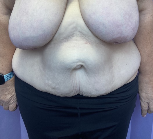 Before: 360° Belt Lipectomy AP