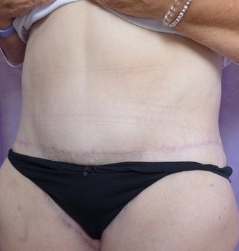 After: 360° Belt Lipectomy oblique view