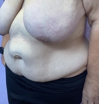 Before: 360° Belt Lipectomy oblique view