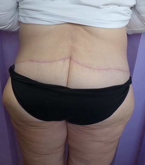 After: 360° Belt Lipectomy posterior view