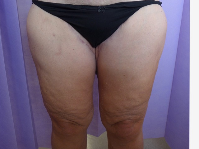 After: Thigh Lift AP