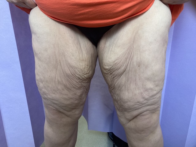 Before: Thigh Lift AP