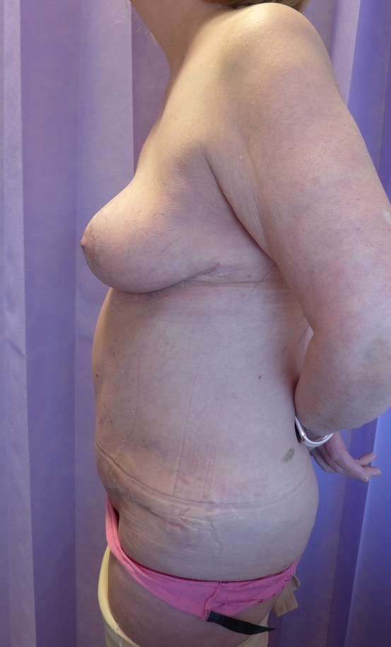 After — Breast Reduction & Abdominoplasty lateral