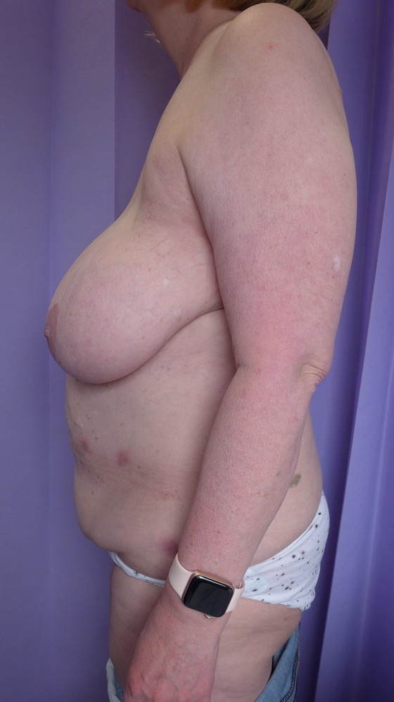 Before — Breast Reduction & Abdominoplasty lateral