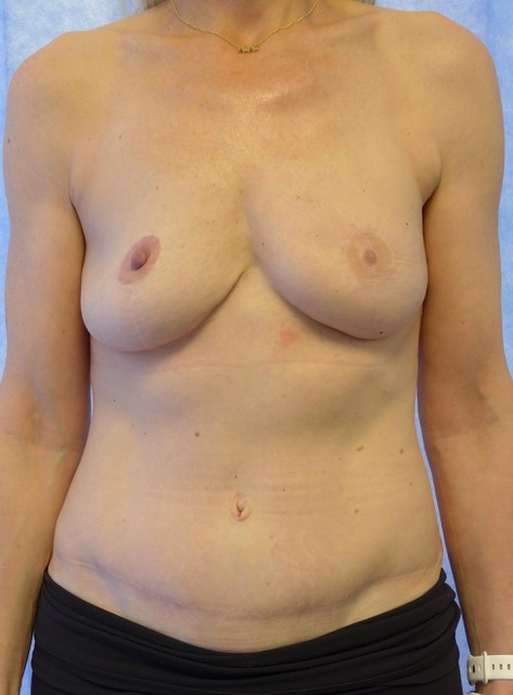 After — Bipedicled DIEP flap breast reconstruction with symmetrising reduction and nipple reconstruction AP
