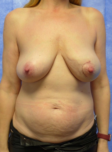 Before — Bipedicled DIEP flap breast reconstruction with symmetrising reduction and nipple reconstruction AP