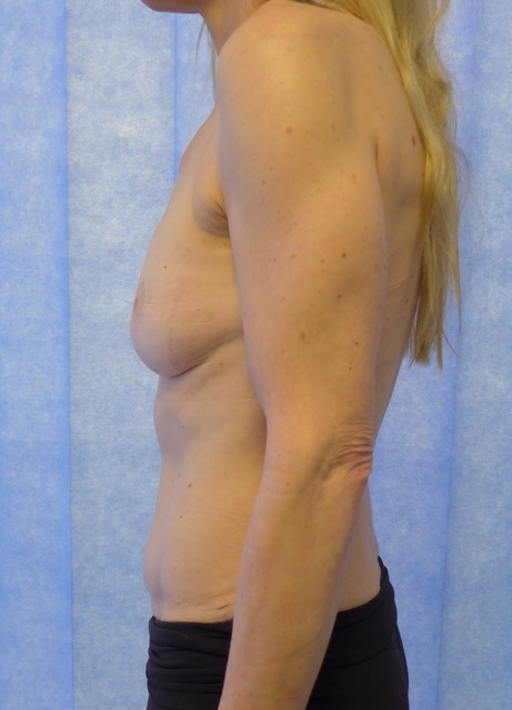 After — Bipedicled DIEP flap breast reconstruction lateral