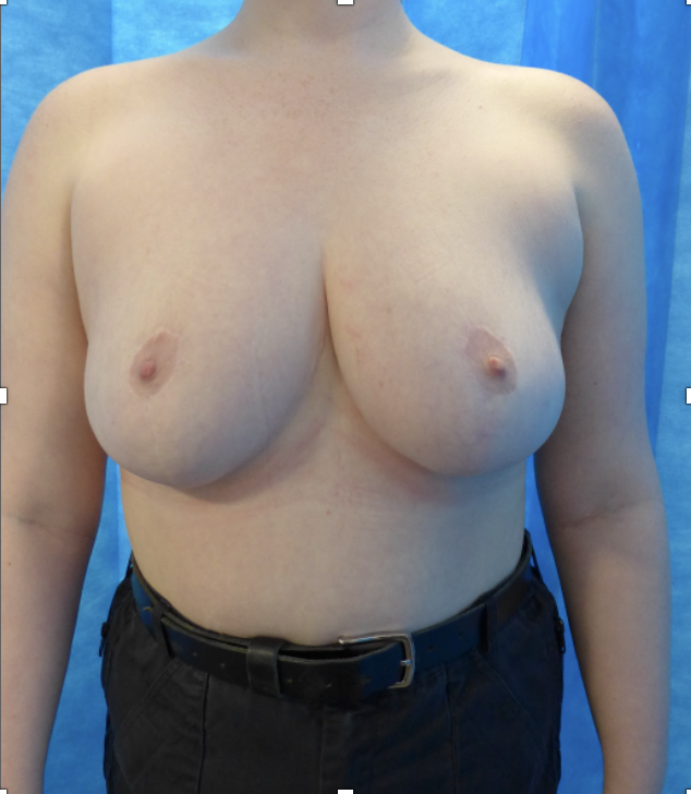 After — 950g Breast Reduction AP