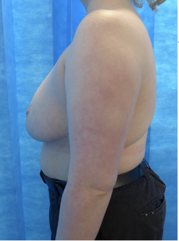 After — 950g Breast Reduction lateral