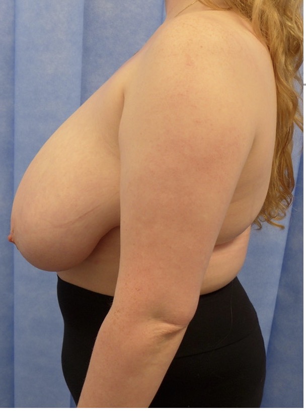 Before — 950g Breast Reduction lateral