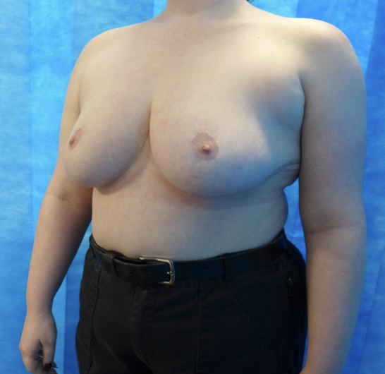 After — 950g Breast Reduction oblique