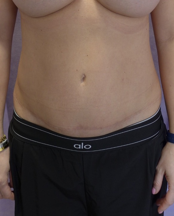 After — Abdominoplasty with rectus plication AP