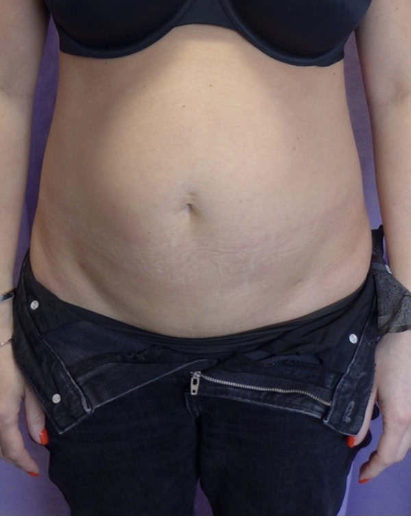 Before — Abdominoplasty with rectus plication AP