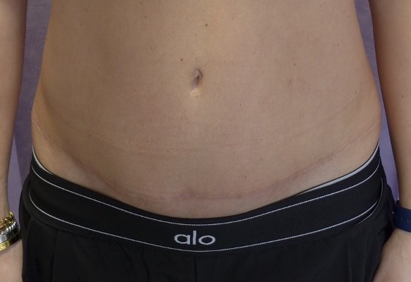 After — Abdominoplasty with rectus plication AP view