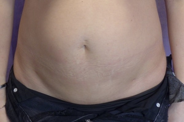 Before — Abdominoplasty with rectus plication AP view