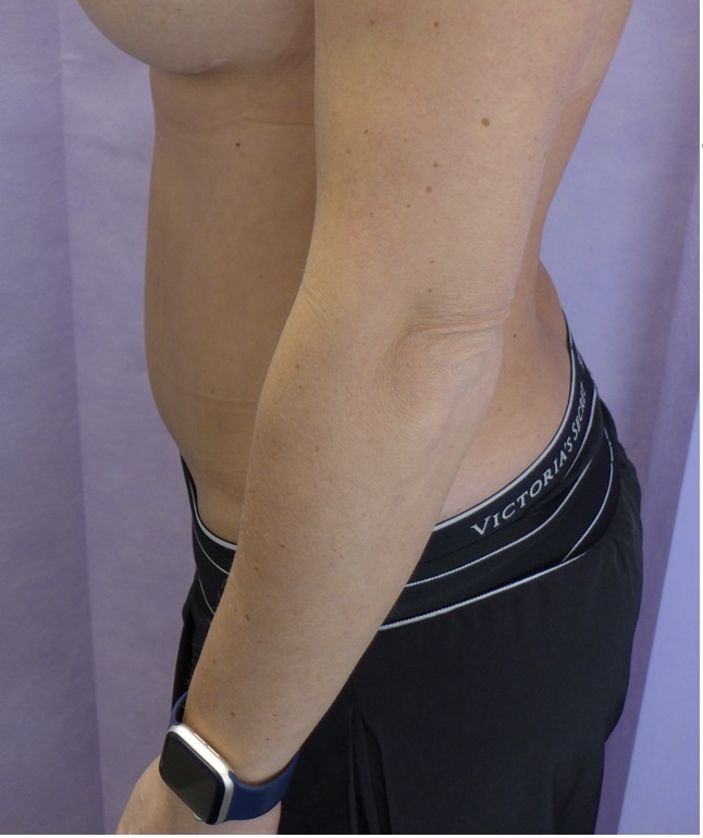 After — Abdominoplasty with rectus plication lateral