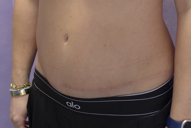 After — Abdominoplasty with rectus plication oblique view
