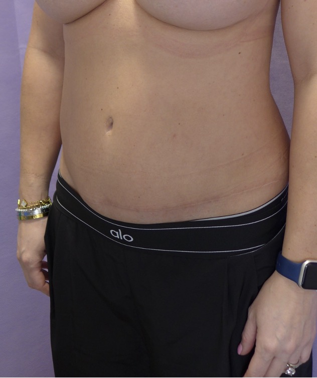 After — Abdominoplasty with rectus plication oblique