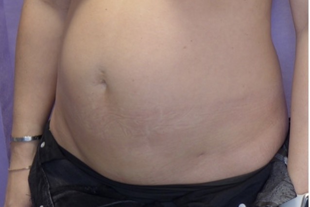 Before — Abdominoplasty with rectus plication oblique view