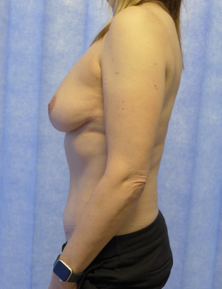 After — DIEP flap breast reconstruction lateral