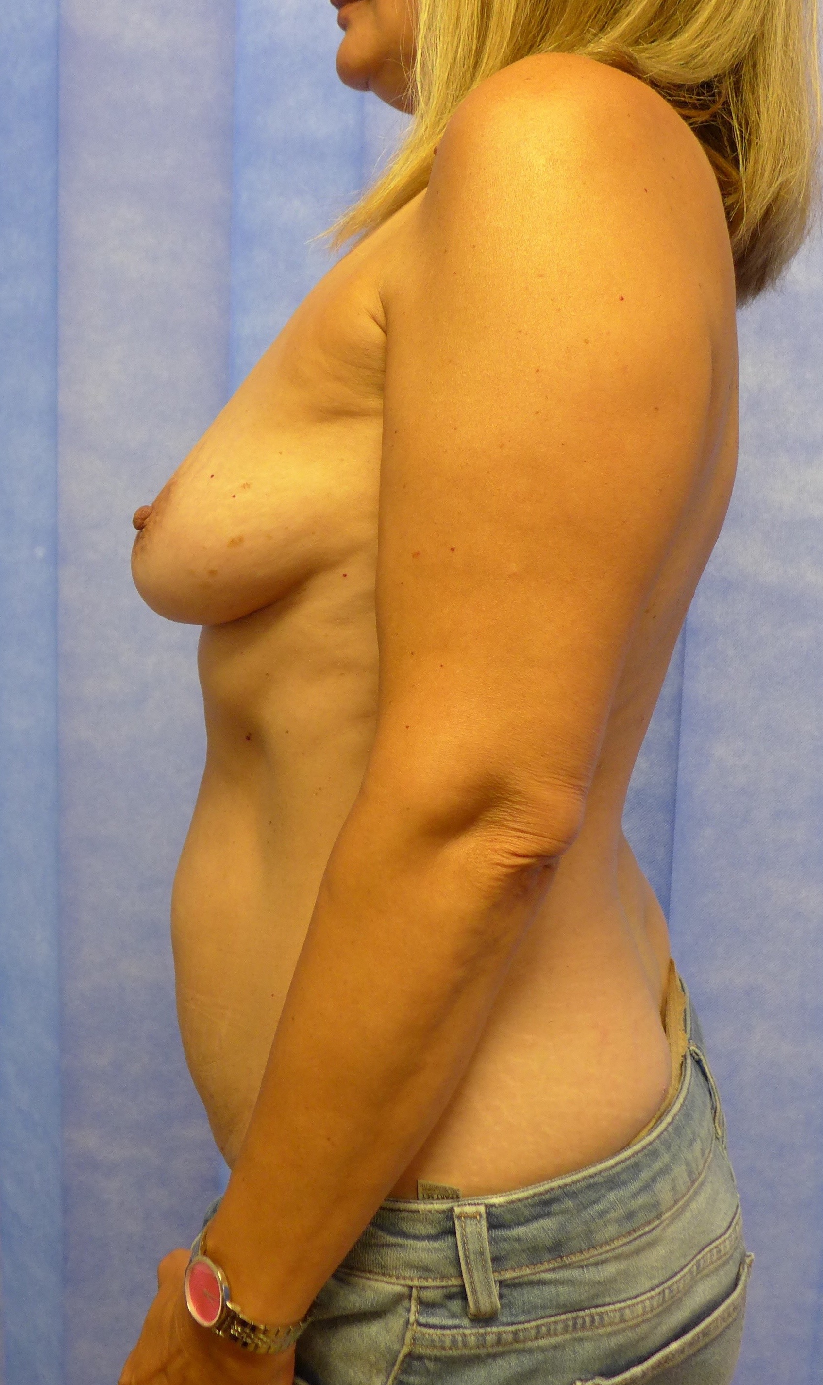 Before — Delayed bipedicled DIEP flap breast reconstruction lateral