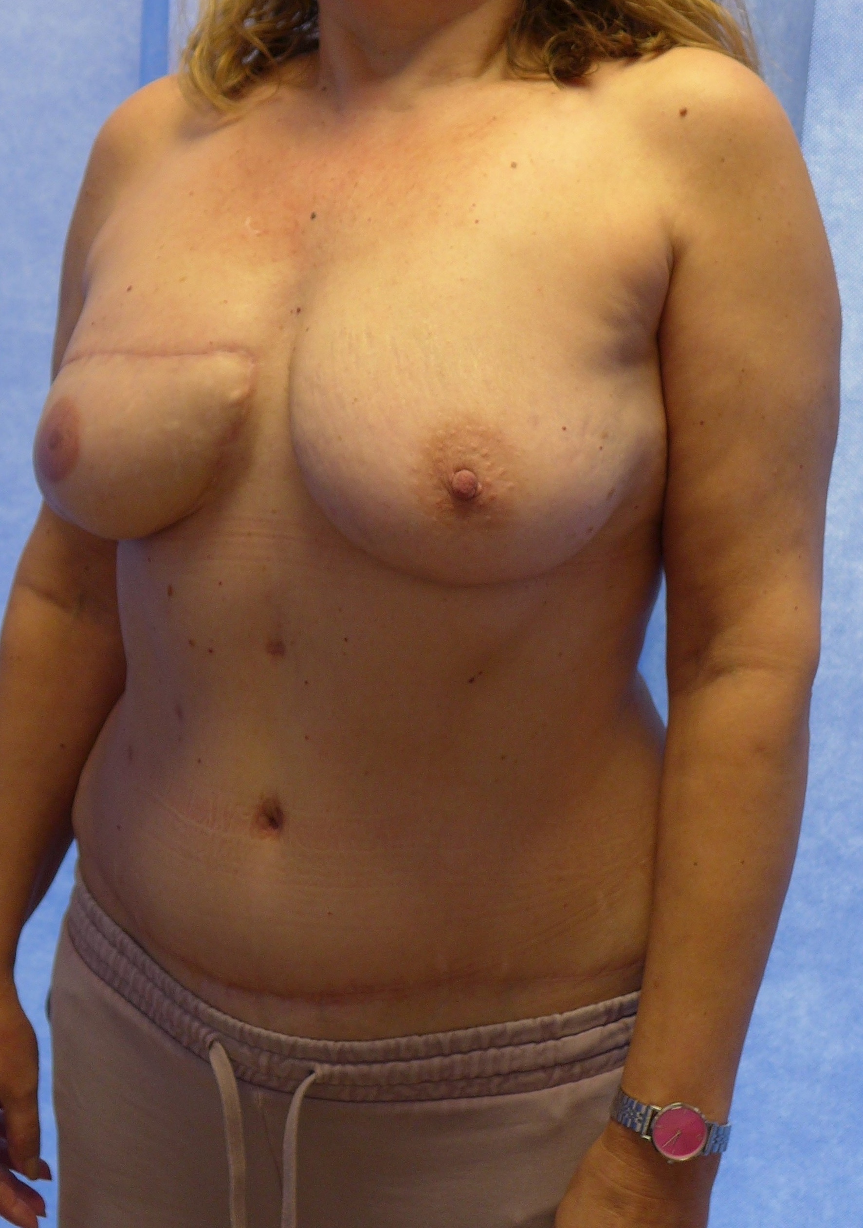 After — Delayed bipedicled DIEP flap breast reconstruction oblique