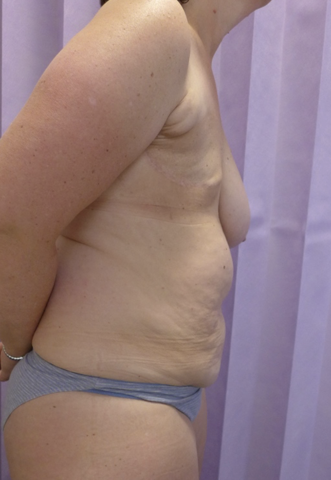 Before — Delayed DIEP Flap Breast Reconstruction lateral