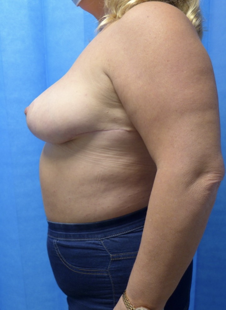 After — Symmetrising Breast Reduction lateral