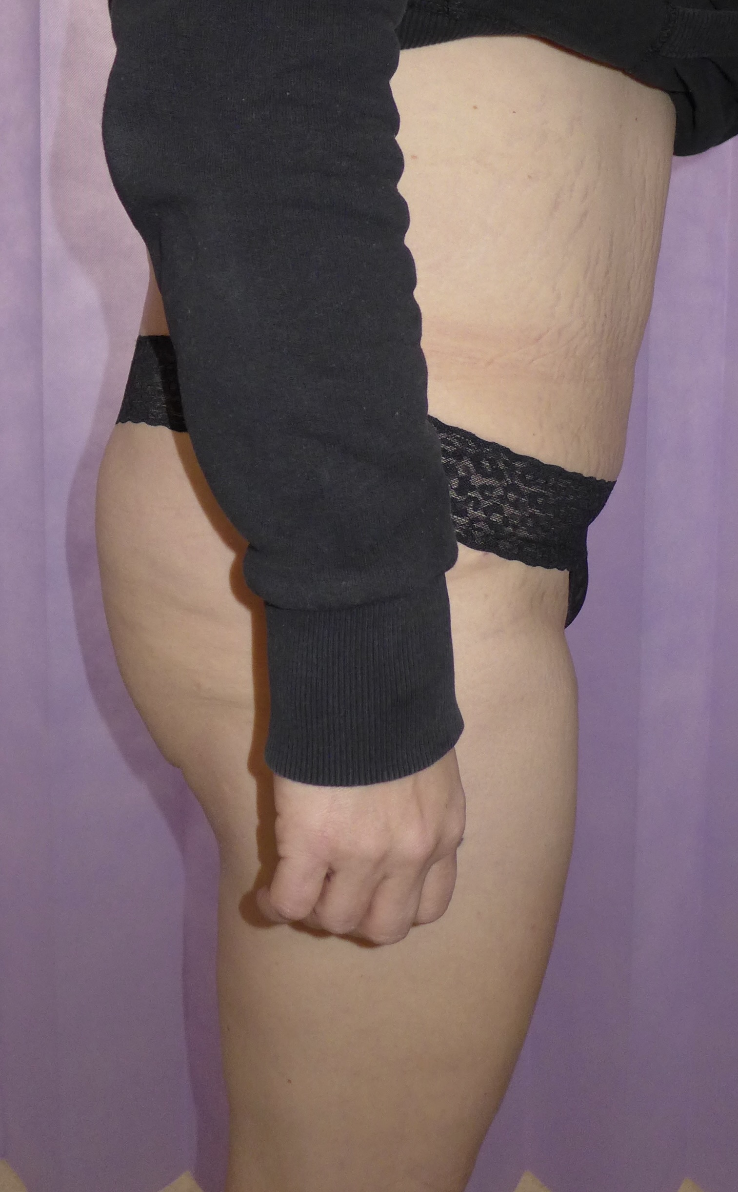 After — Fleur-de-Lys Abdominoplasty lateral view