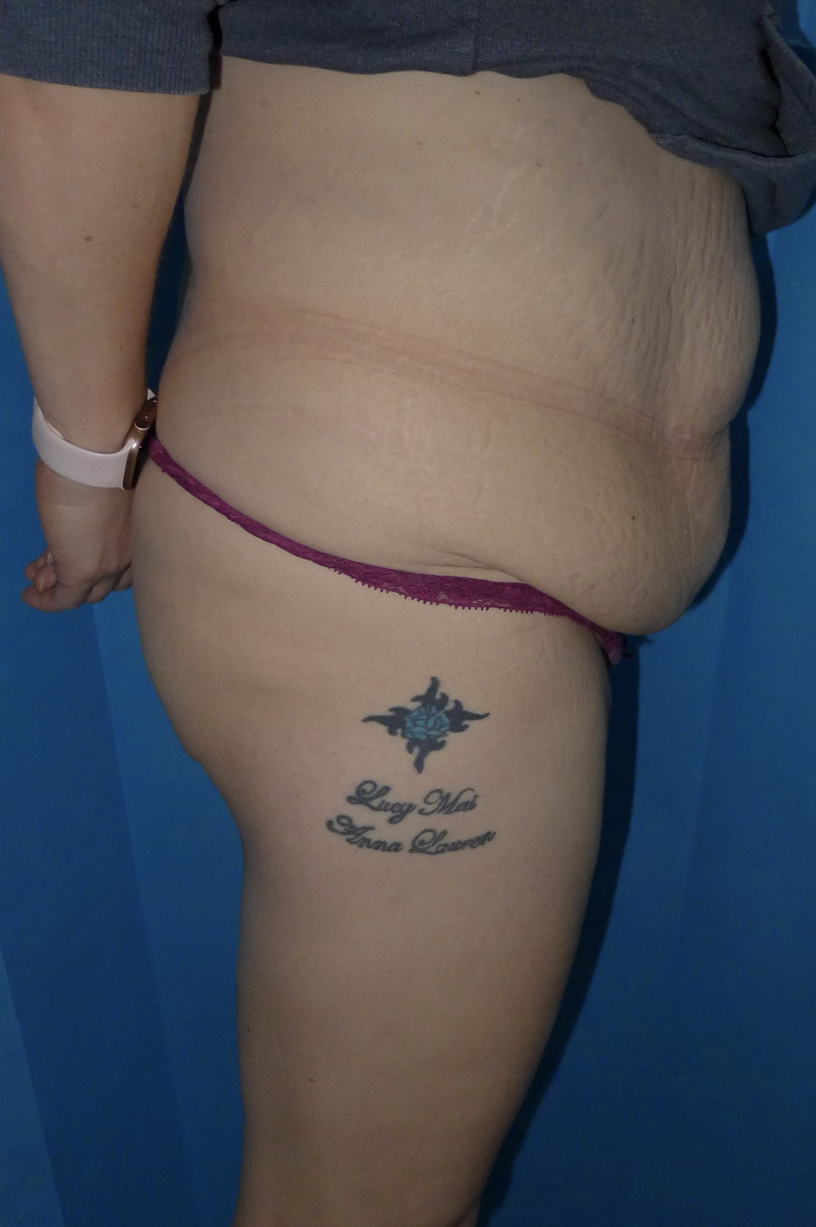 Before — Fleur-de-Lys Abdominoplasty lateral view