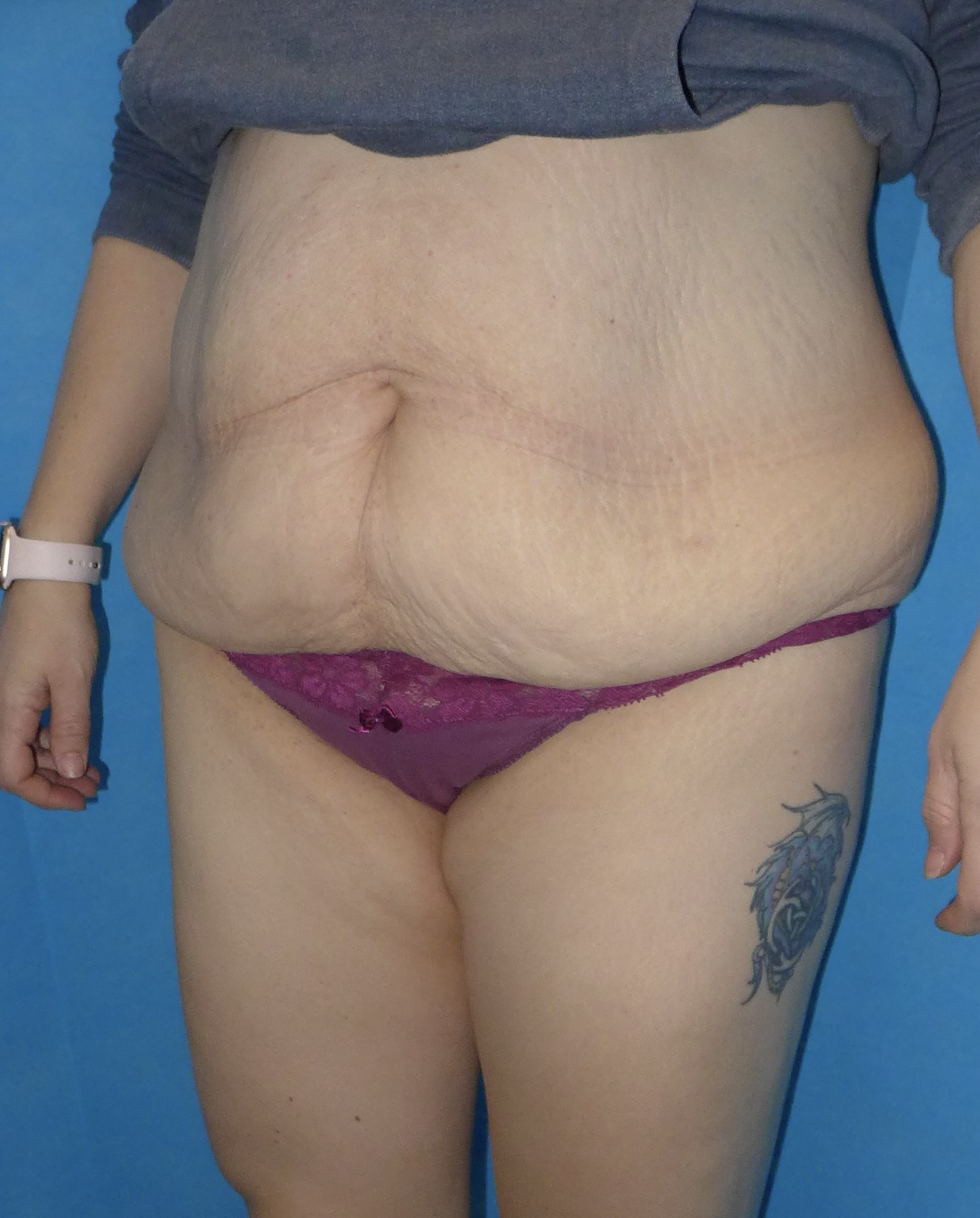 Before — Fleur-de-Lys Abdominoplasty
