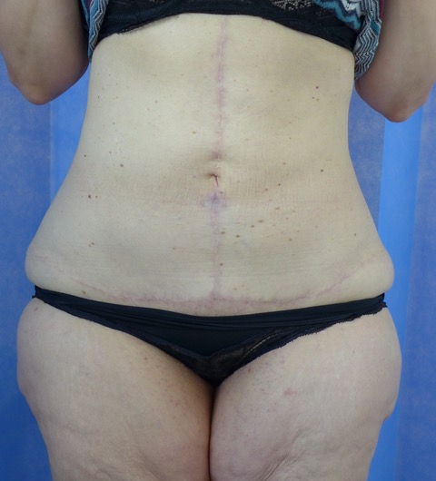 After — Fleur-de-Lys Abdominoplasty