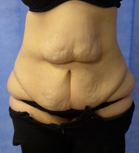 Before — Fleur-de-Lys Abdominoplasty